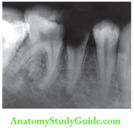 Pathologies Of Pulp And Periapex Notes Radiograph showing a large carious lesion in premolar resulting in pulp necrosis.