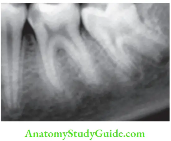 Pathologies Of Pulp And Periapex Notes Radiograph showing carious exposure of pulp in fist molar