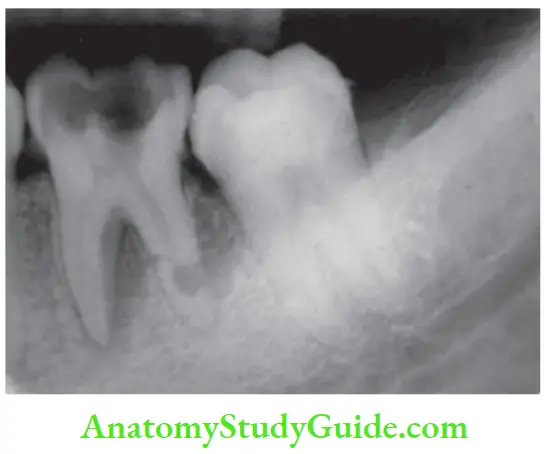 Pathologies Of Pulp And Periapex Notes Radiograph showing internal resorption in distal root of mandibular fist molar.