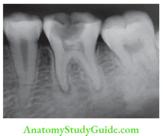 Pathologies Of Pulp And Periapex Notes Radiograph showing pulp stone in pulp chamber of mandibular fist molar.