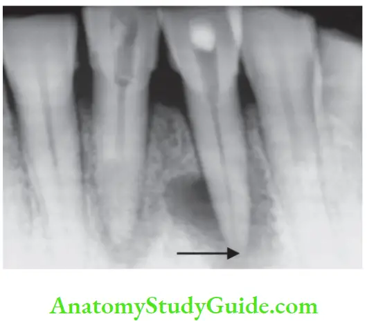 Pathologies Of Pulp And Periapex Notes Radiographic appearance of external root resorption of mandibular central incisor