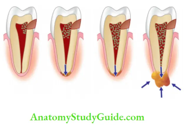 Pathologies Of Pulp And Periapex Notes Schematic representation of gradual pulpal response to dental caries.