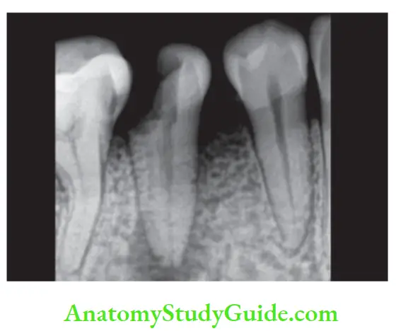 Pathologies Of Pulp And Periapex Notes apex of mandibular