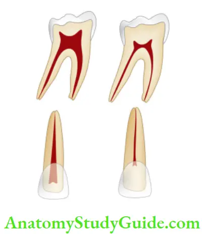 Pathologies Of Pulp And Periapex Notes decrease in size of pulp cavity of anterior and posterior teeth due to secondary dentin deposition WITH AGE