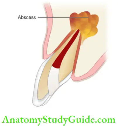 Pathologies Of Pulp And Periapex Notes periapical abscess.