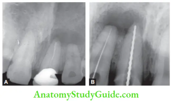 Pathologies Of Pulp And Periapex Notes periapical radiolucency in relation to maxillary central and lateral incisors, Working length determination
