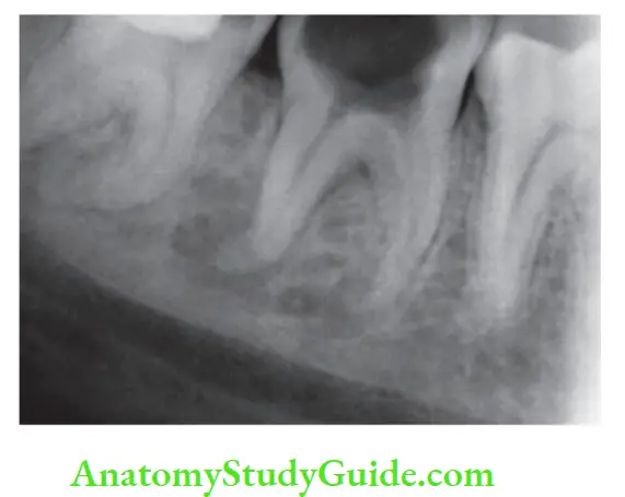 Pathologies Of Pulp And Periapex Notes untreated caries in mandibular second molar resulting in periapical pathology.
