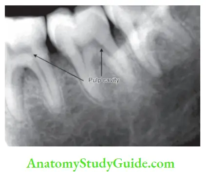 Pulp And Periradicular Tissue Notes Radiographic appearance of pulp cavity.