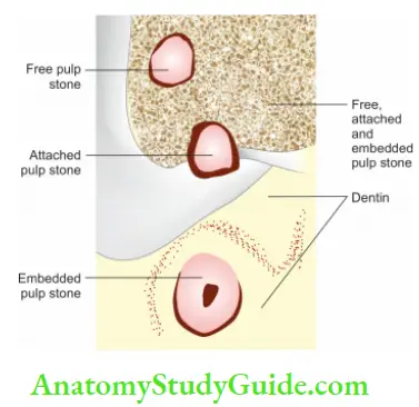 Pulp And Periradicular Tissue Notes Schematic representation of free, attached, and embedded pulp stones.