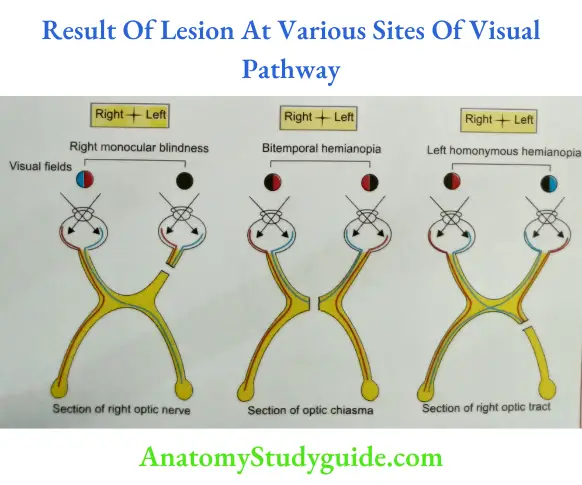 Result Of Lesion At Various Sites Of Visual Pathway