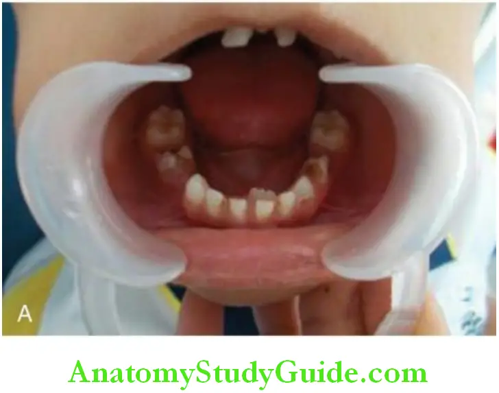 Shedding Of Teeth permanet mandibular incisor lingual to the still functioning primary mandibukar incisors