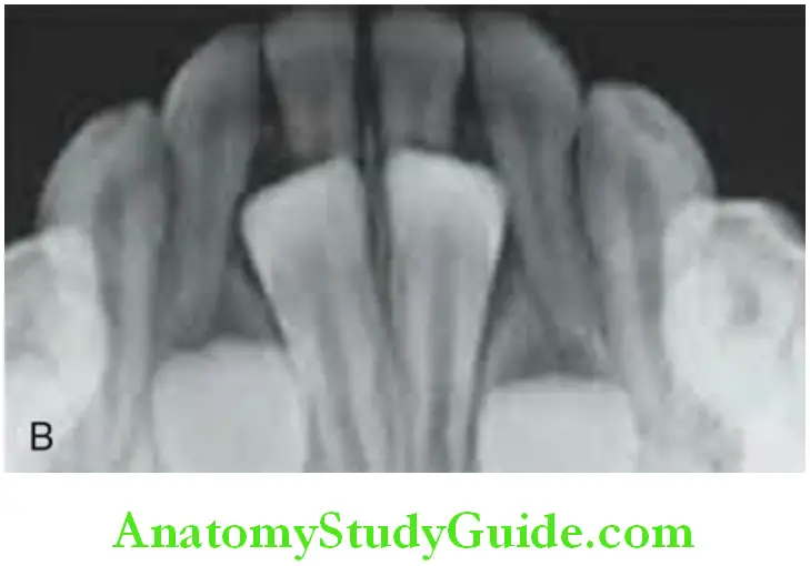 Shedding Of Teeth radiograph permanent mandibular incisors lingual to the still functioning primary mandibular incisors