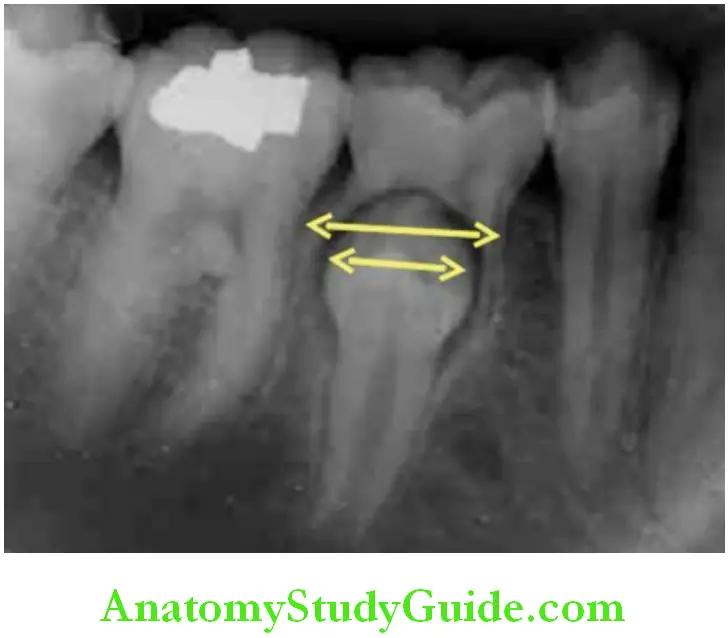 Shedding Of Teeth radiograph permanent premolars positioned between the flaring roots of the deciduous molars