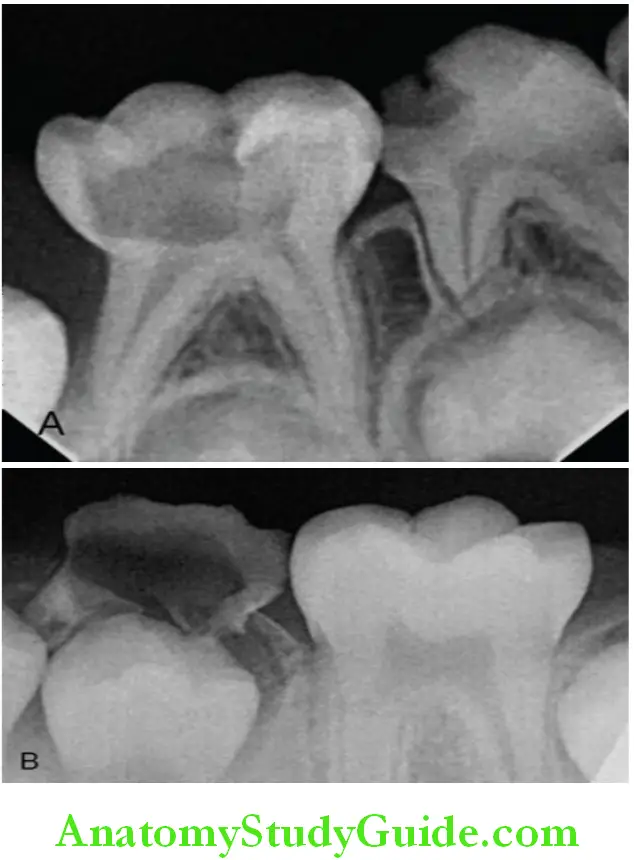 Shedding Of Teeth radiograph permanent tooth germ causing resorption of the deciduous tooth and forming an eruption pathway