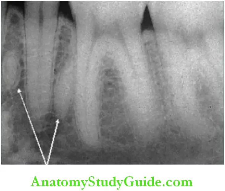Shedding Of Teeth radiograph retained deciduous root in between the roots of the permanent teeth.
