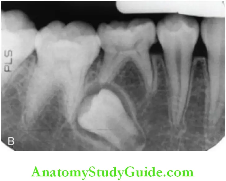 Shedding Of Teeth radiograph retained deciduous root in between the roots of the permanent teeth