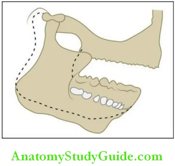 Temporomandibular joint position of the condyle after mouth opening translaton