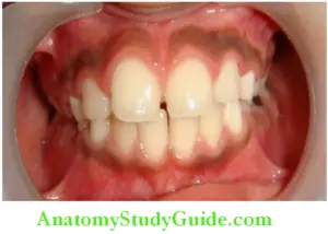 Oral Anatomy The Mixed Dentition Malocclusion Period Notes - Anatomy