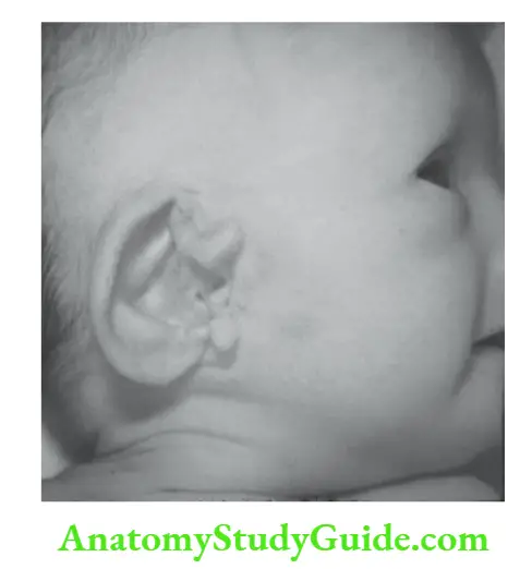 The dysmorphic chid Preauricular skin tags in a child with Turner syndrome