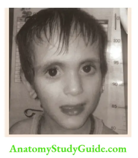 The dysmorphic child A 2-year-old boy with Sotos syndrome