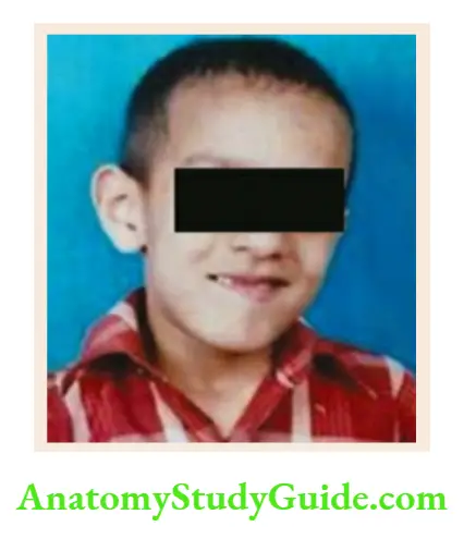 The dysmorphic child Fragile X syndrome. Note long face, large ears and prominent broad chin.