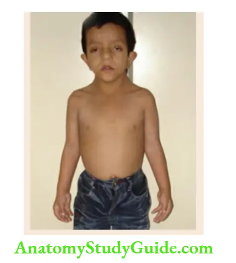 The dysmorphic child Noonan syndrome in a boy.