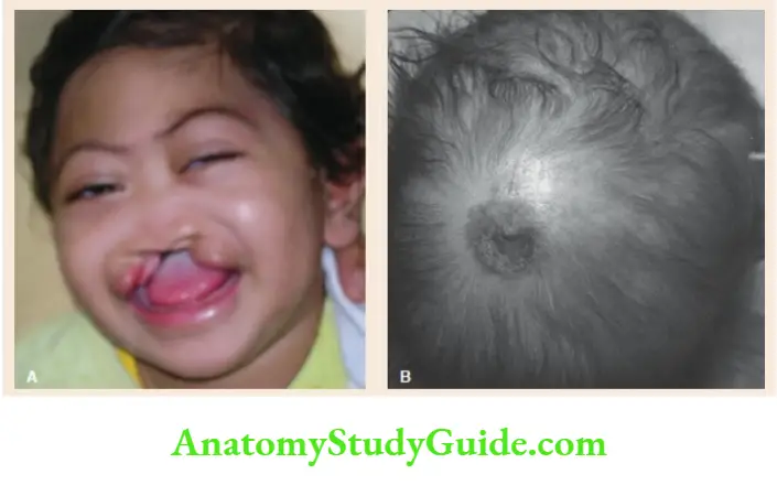 The dysmorphic child Patau syndrome