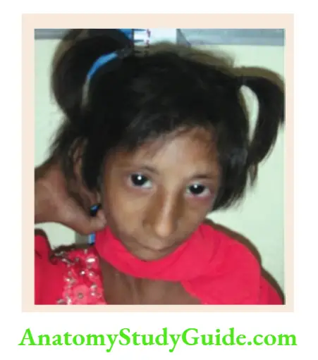 The dysmorphic child Seckel syndrome.