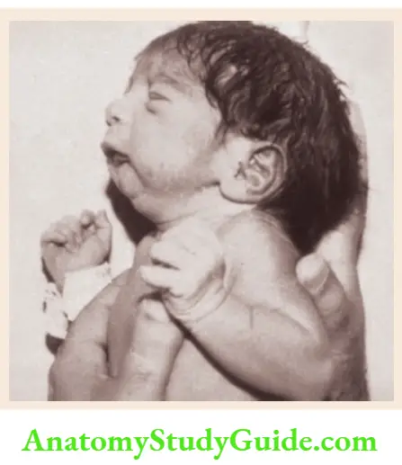 The dysmorphic child Typical appearances of micrognathia and retrognathia in an infant with Pierre Robin syndrome.