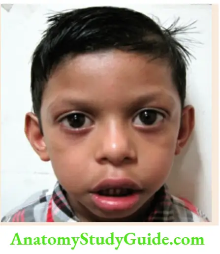 The dysmorphic child Williams syndrome. Prominent eyes, periorbital fullness, and thick patulous lips.