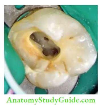 Access Cavity Preparation Access cavity of maxillary fist molar showing MB1, MB2, distal and palatal canals.