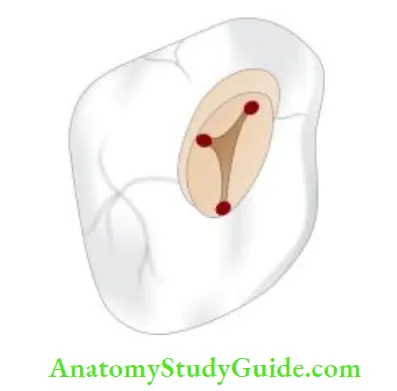 Access Cavity Preparation Access cavity preparation of maxillary second molar here mesiobuccal orifie is located more mesial and buccal than fist molar.