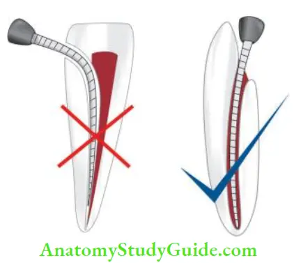Access Cavity Preparation An adequate access cavity preparation should permit straight line access to apical foramen.