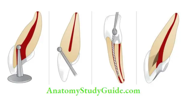 Access Cavity Preparation Errors during access cavity preparation of anterior teeth