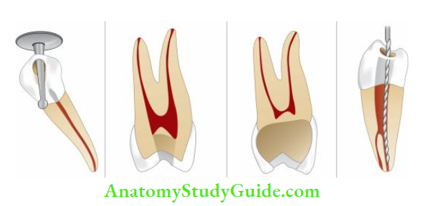 Access Cavity Preparation Errors in cavity preparation of premolars
