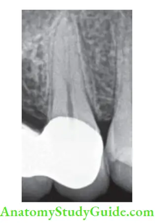 Access Cavity Preparation If sharp break is seen in main canal in radiograph, one should suspect bifurcation or trifurcation of the canal.