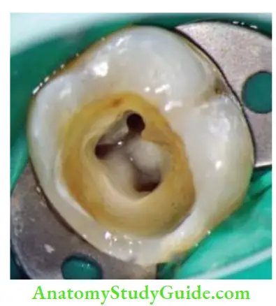 Access Cavity Preparation Law of CEJ; Distance from external surface of clinical crown to the wall of pulp chamber is same throughout the tooth circumference at the level of CEJ.
