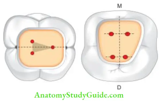 Access Cavity Preparation Law of symmetry- Canal orifies are equidistant from a line drawn in mesiodistal direction through the flor of pulp chamber.