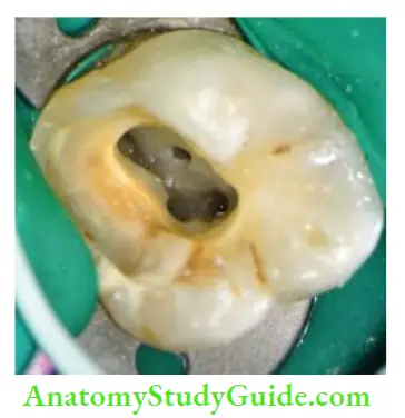 Access Cavity Preparation Magnifiation helps in better visualization of canal anatomy.