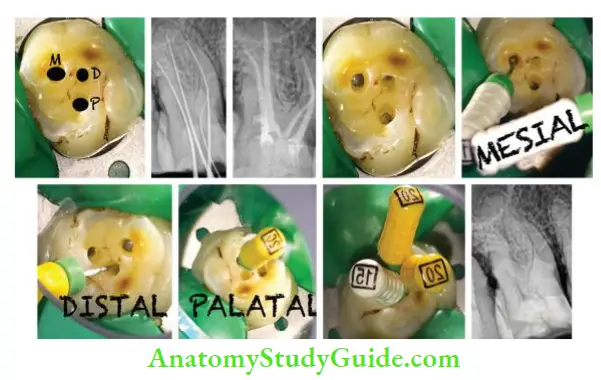 Access Cavity Preparation Management of maxillary fist molar by Ninja access.
