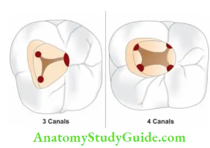Access Cavity Preparation Mandibular fist molar showing-Three canals; Four canals.