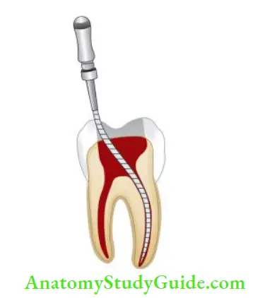 Access Cavity Preparation Not removing dentin from mesial wall causes bending of instrument while inserting in canal leading to instrumental errors