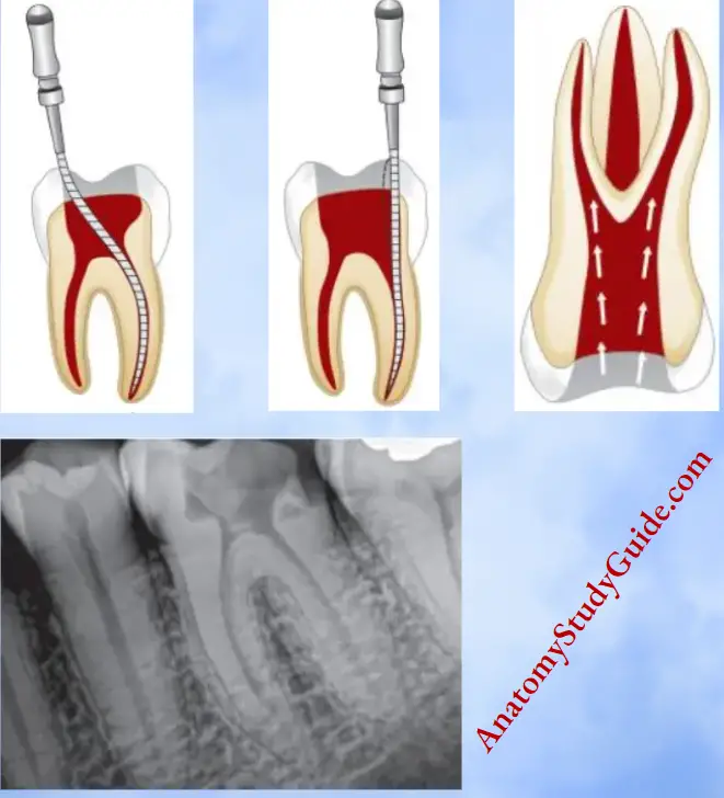 Access Cavity Preparation Notes Access Cavity Preparation Definition