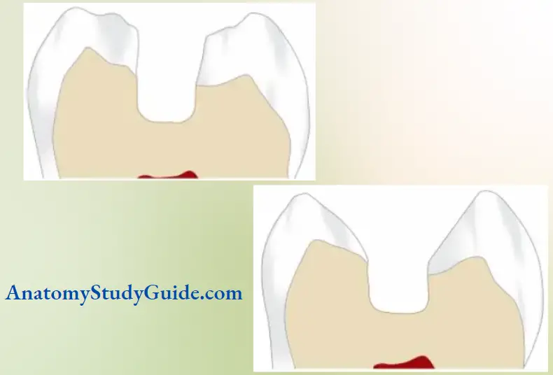 Access Cavity Preparation Notes Cavosurface design