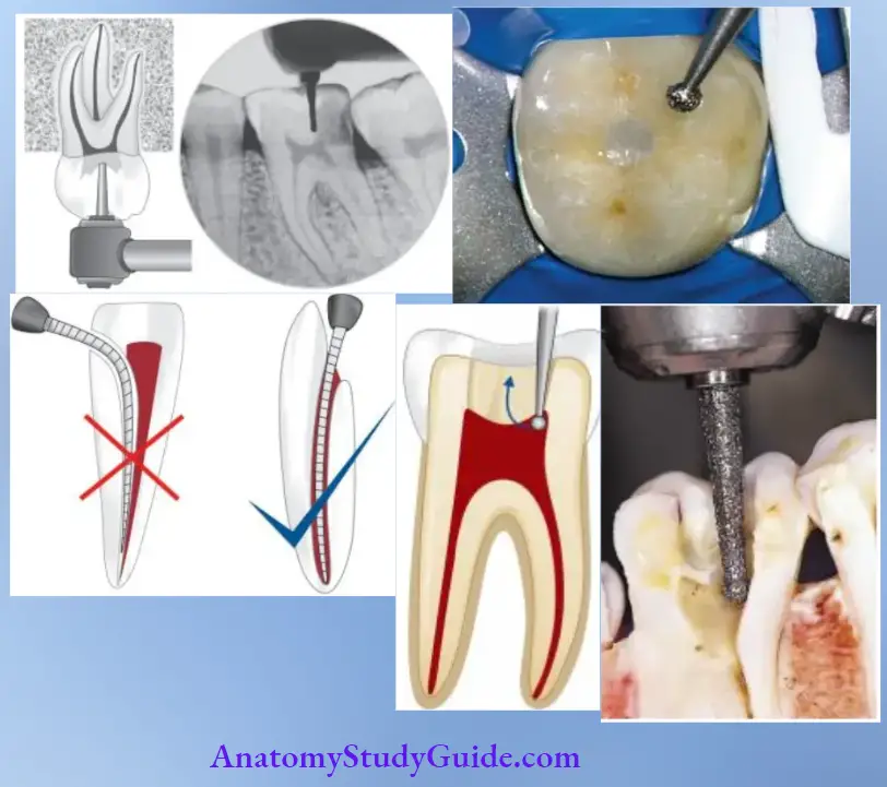 Access Cavity Preparation Notes Guidelines For Access Cavity Preparation