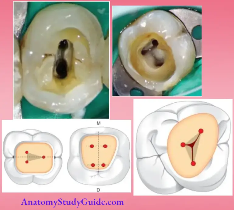 Access Cavity Preparation Notes Laws Of Access Cavity Preparation For Locating Canal Orifies