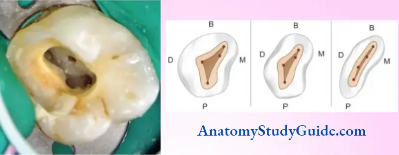 Access Cavity Preparation Notes Maxillary First Molar