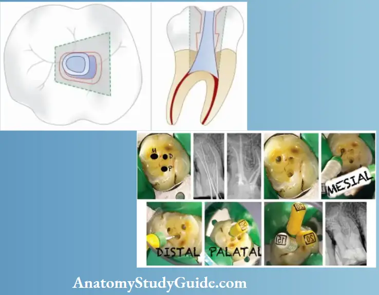 Access Cavity Preparation Notes Minimal Invasive Endodontics Or Recent Trends In Endodontic Access Preparation