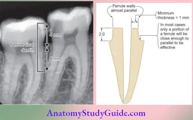 Access Cavity Preparation Notes Preserve tooth structure for three dimensional ferrule