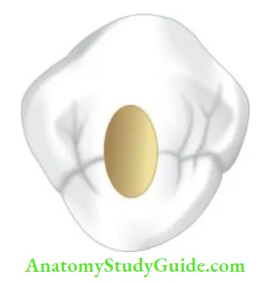 Access Cavity Preparation Occlusal view of access cavity preparation of mandibular premolar.